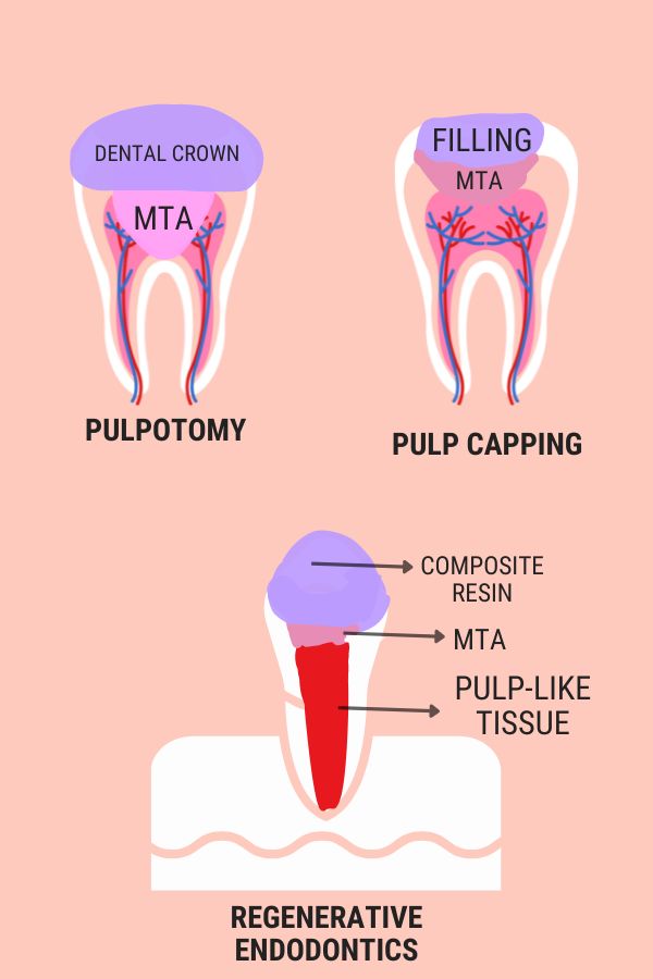 Alternative to root canal treatment Istanbul Turkey