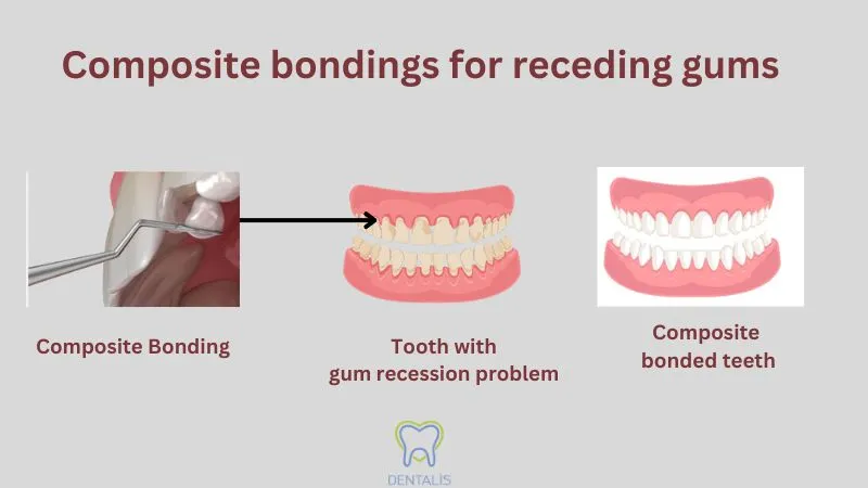 composite bonding for receding gums