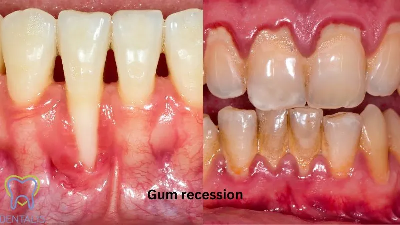 Gum recession treatment in Turkey