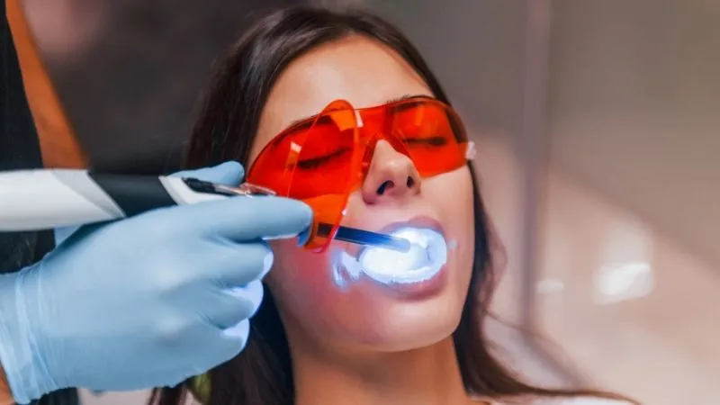 How long do composite veneers last
