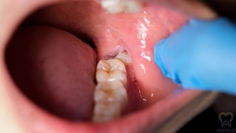 Wisdom teeth removal in Turkey