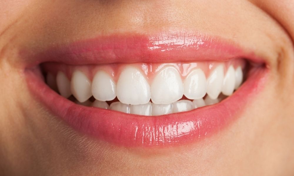 Emax veneer photo Turkey
