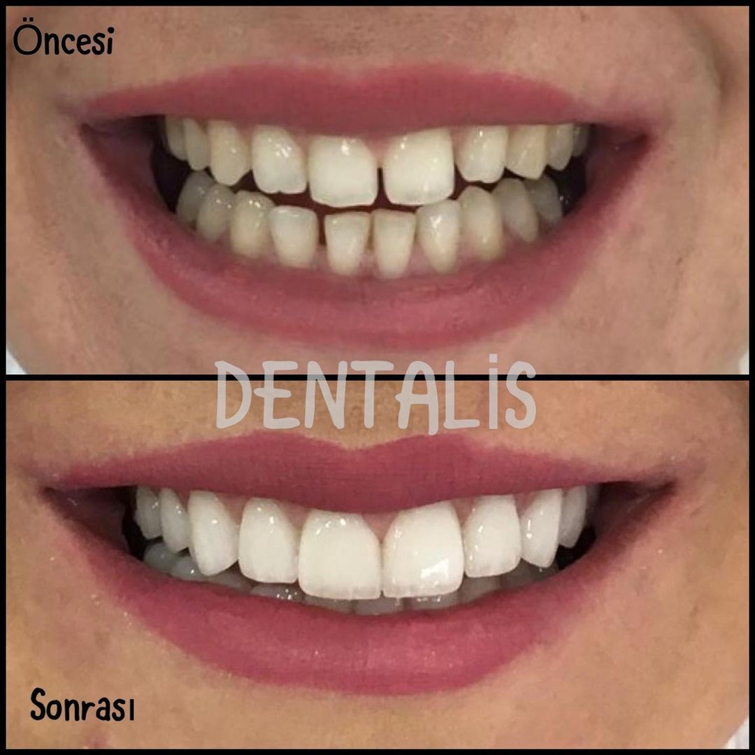 Veneers Istanbul